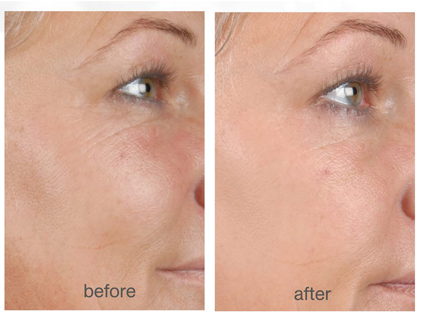 Live Cell Therapy Before and After - La Bella Spa
